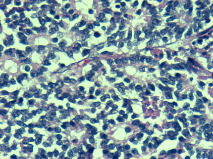 Figura 5: Mayor aumento de la vista antrior que muestra mejor la formacin de pseudorosetas. H/E 20X
